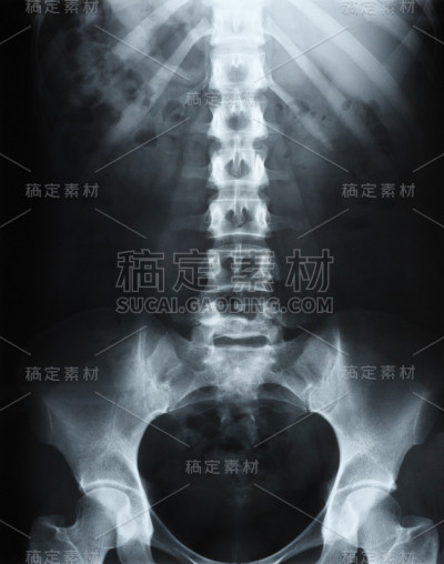 人类脊柱x射线