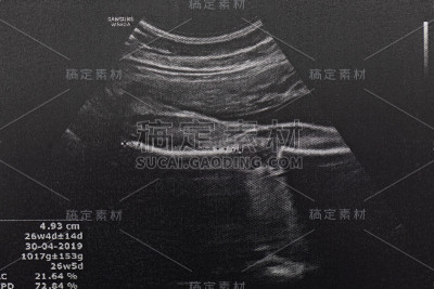 孕妇胎儿超声检查，医生通过超声读取孕妇检测结果。