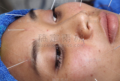 近手进行医学专业针灸治疗