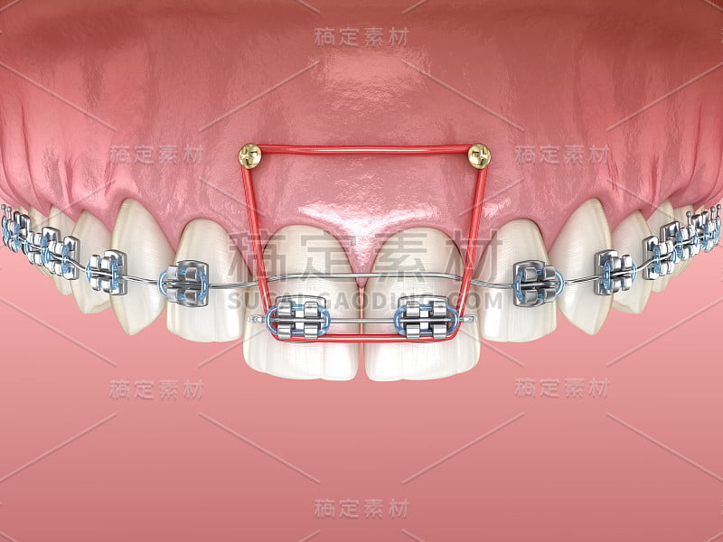 矫正前门牙覆咬用的弹性及金属支具。医学上准确的牙科3D插图