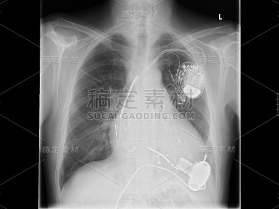 x光片，胸部，心脏起搏器