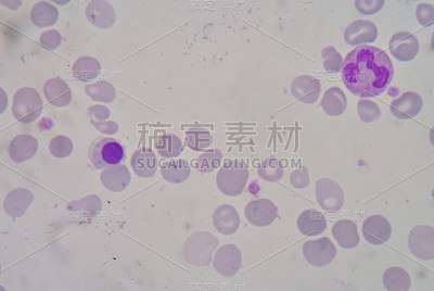 β地中海贫血(Î²地中海贫血)是一组