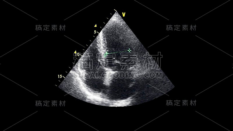 经食管超声检查心脏图像。