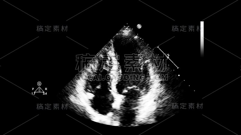 经食管超声检查心脏图像。