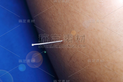 近手进行医学专业针灸治疗