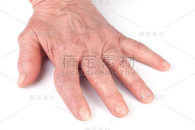 白色背景下孤立的手类风湿性多关节炎