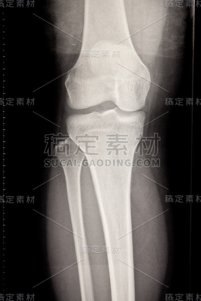 膝盖x射线