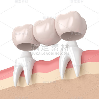 牙桥与牙冠的3d渲染