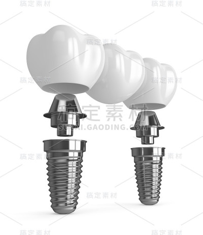 种植体与牙桥的3d渲染