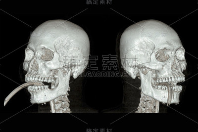 电脑断层扫描大脑的一系列图像