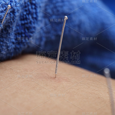 近手进行医学专业针灸治疗