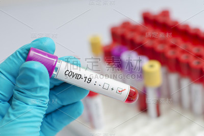 血液样管呈COVID-19病毒阳性