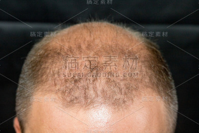 男性脱发/秃顶