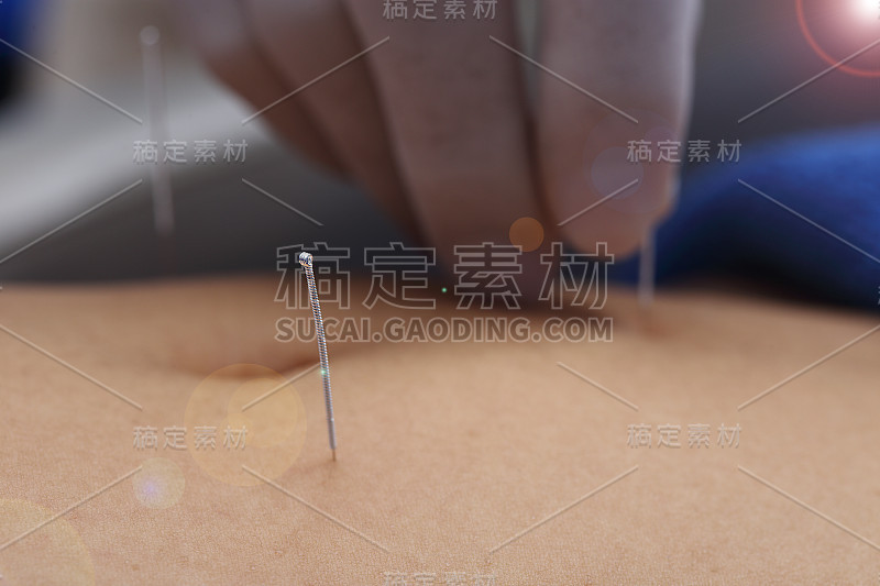 近手进行医学专业针灸治疗