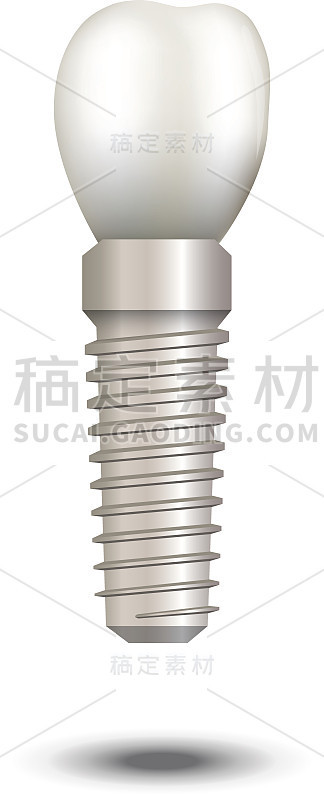 向量现实牙科种植孤立在白色。