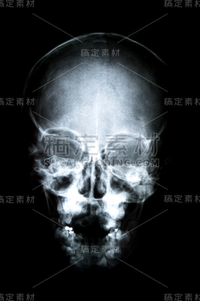 x射线的头