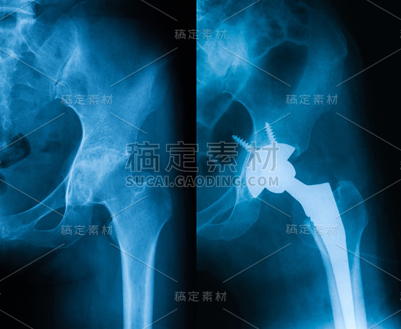 双侧髋关节x线照片显示全髋关节置换术。