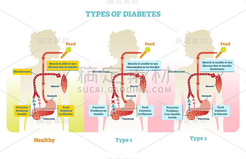 糖尿病类型矢量图解方案