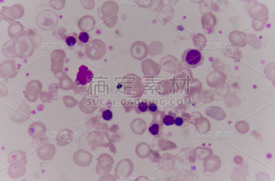 血液涂片中的红细胞异常。