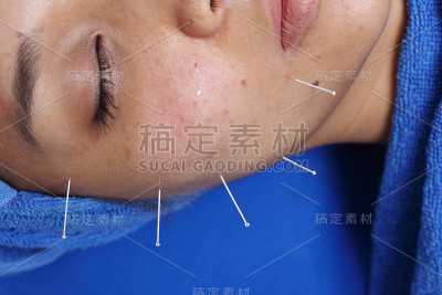 近手进行医学专业针灸治疗