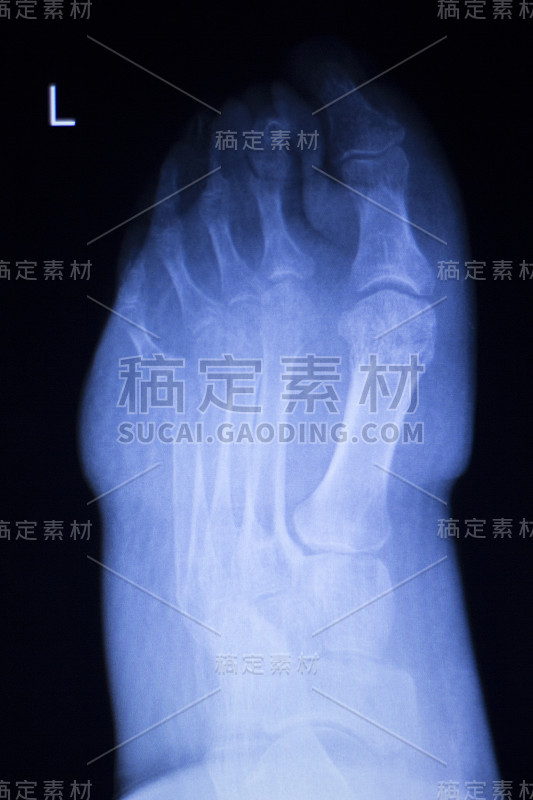 脚和脚趾受伤x光扫描