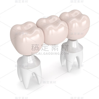 牙桥与牙冠的3d渲染