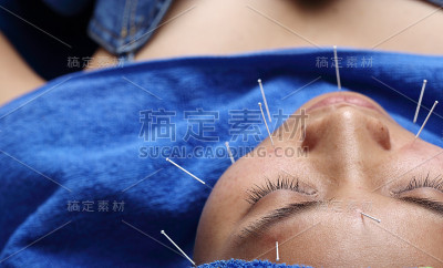 近手进行医学专业针灸治疗