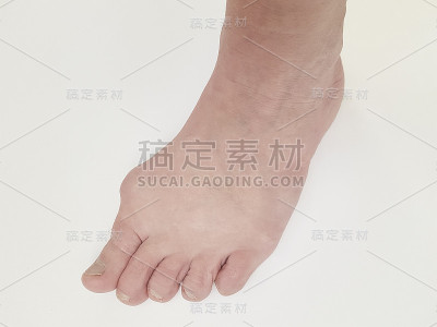 拇外翻，两腿孤立于白色疼痛关节上