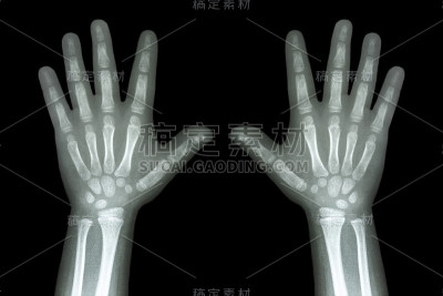 用x射线把孩子的双手放在黑色背景上