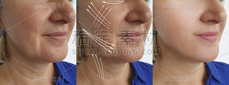 老年妇女脸部皱纹治疗前后箭头
