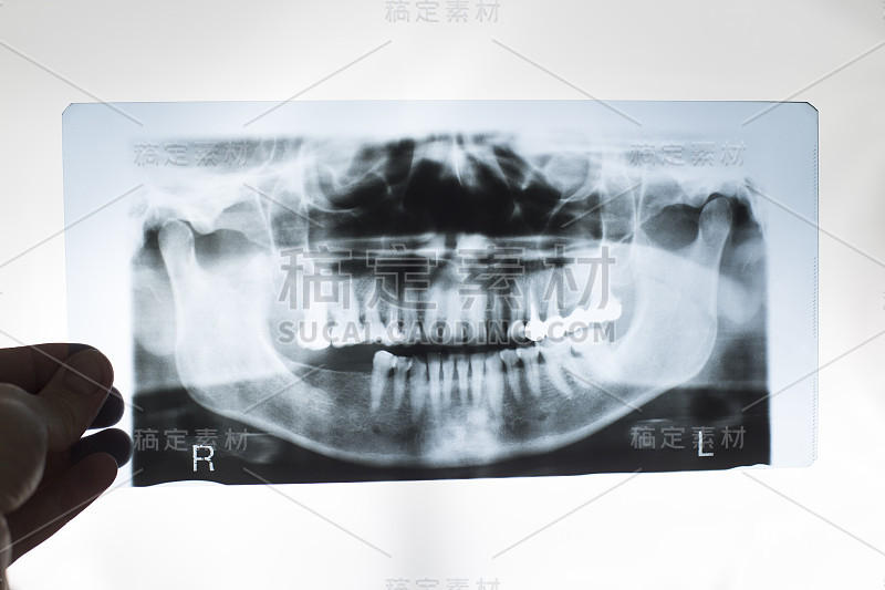 牙医手里拿着一张带假牙的下巴x光照片。金属烤瓷冠修复概念，牙周膜