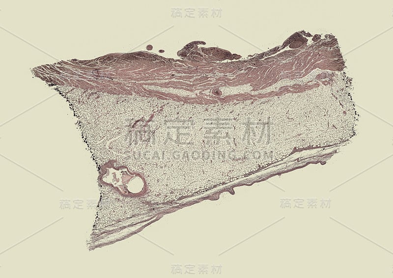 人类病理学-心脏脂肪-循环器官和血液形成器官的损伤