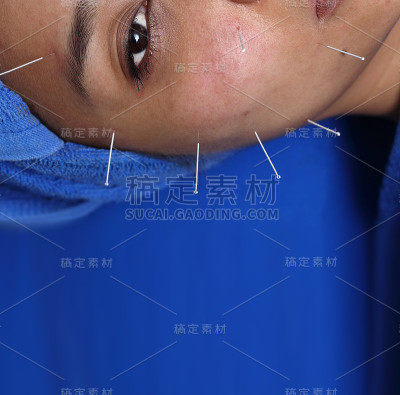 近手进行医学专业针灸治疗