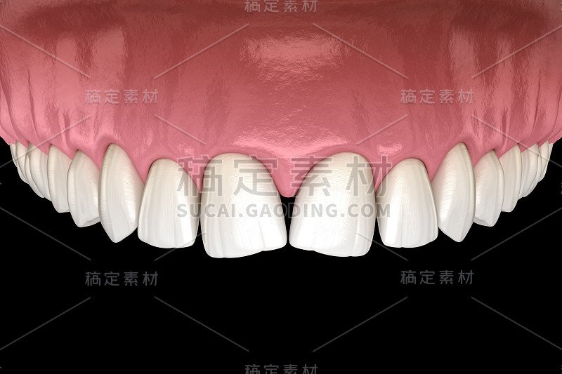 中切牙牙缝会聚。牙科功能障碍3D插图概念