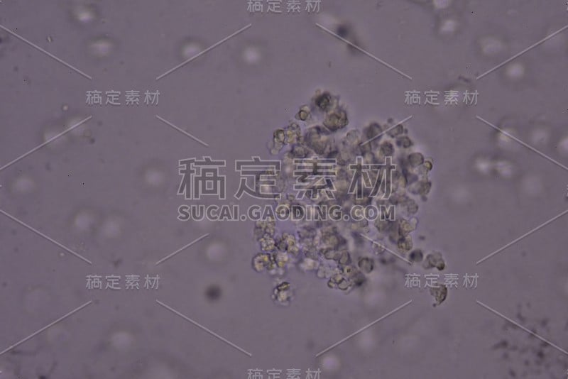 尿囊炎患者白细胞结块。