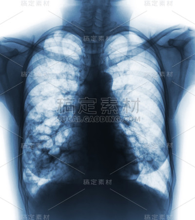支气管扩张。胸部x光片显示慢性感染引起的多个肺泡和囊肿。前视图