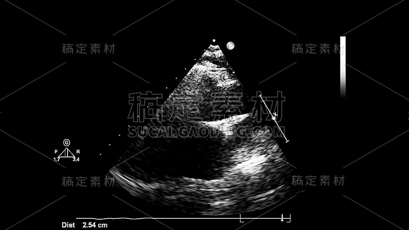 经食管超声检查心脏图像。