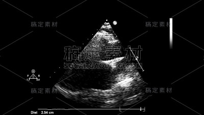 经食管超声检查心脏图像。