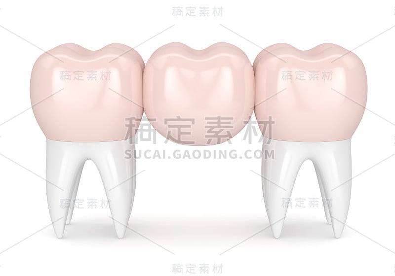 牙桥与牙冠的3d渲染
