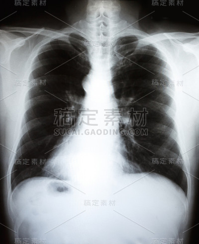 胶片x射线扫描人