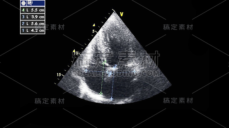 经食管超声检查心脏图像。