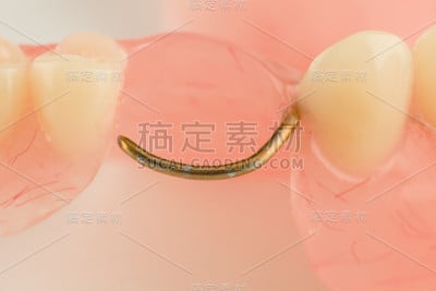 丙烯酸牙科假肢
