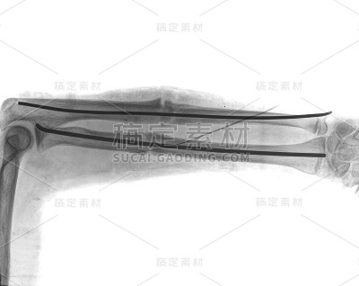 带螺丝断臂
