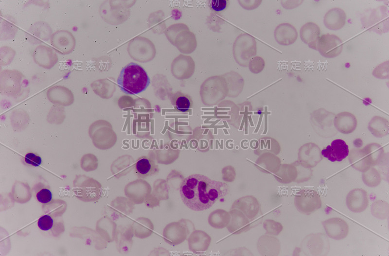 血液涂片中的红细胞异常。