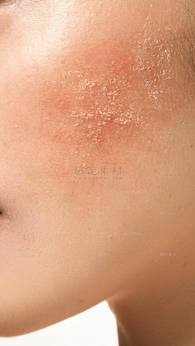 美妆系列写实风人体脸部皮肤爆皮